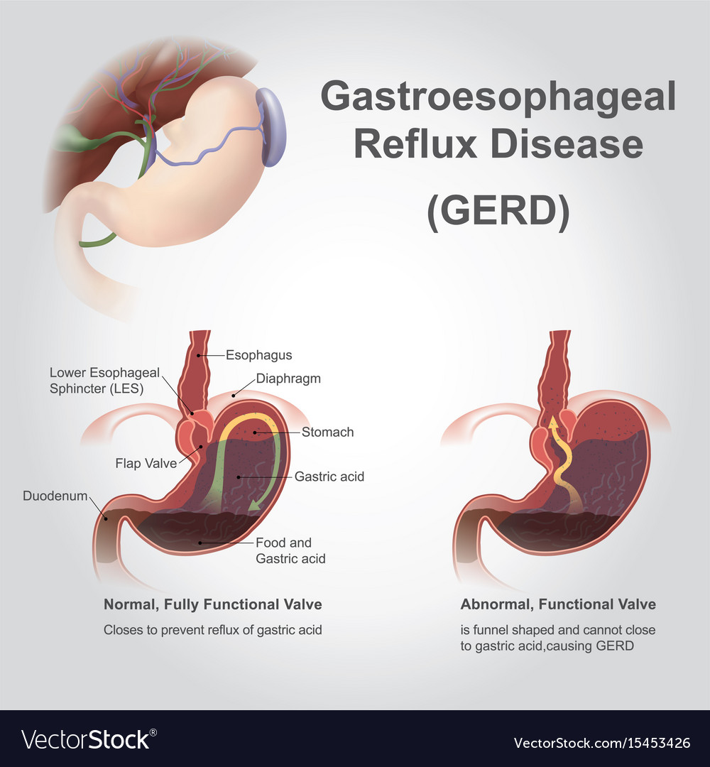 Gastro Reflux Disease Infographic Royalty Free Vector Image