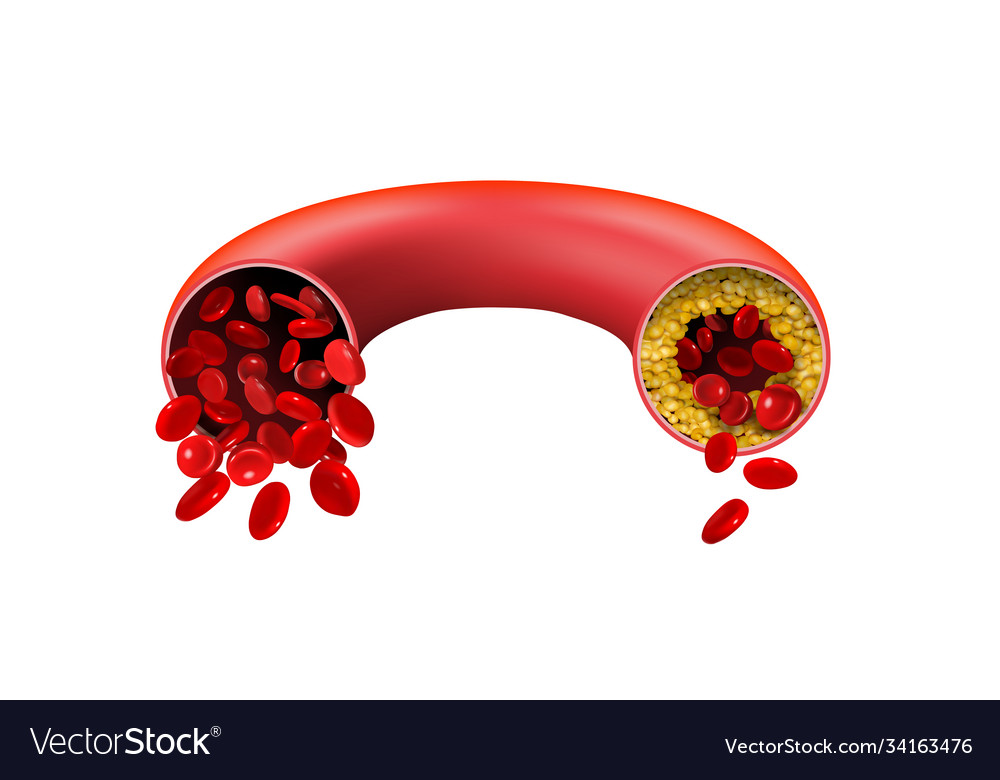 Normal and cholesterol-blocked artery on a white Vector Image