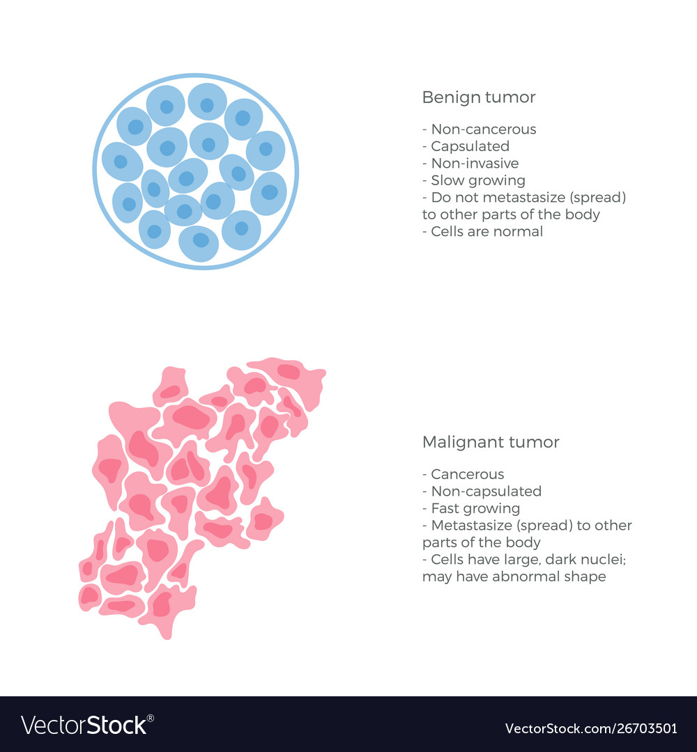 Malignant And Benign Tumor Royalty Free Vector Image