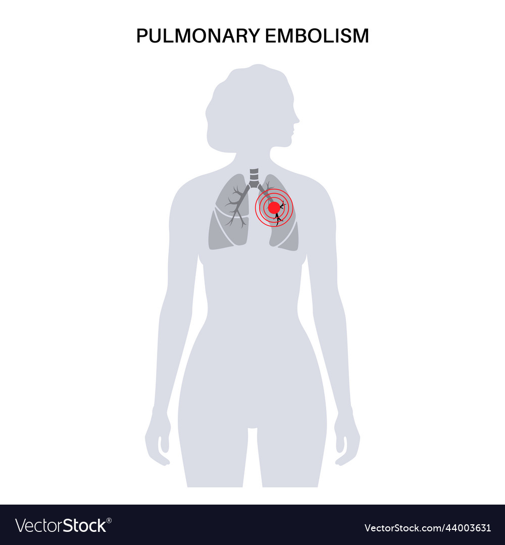 Pulmonary embolism disease Royalty Free Vector Image