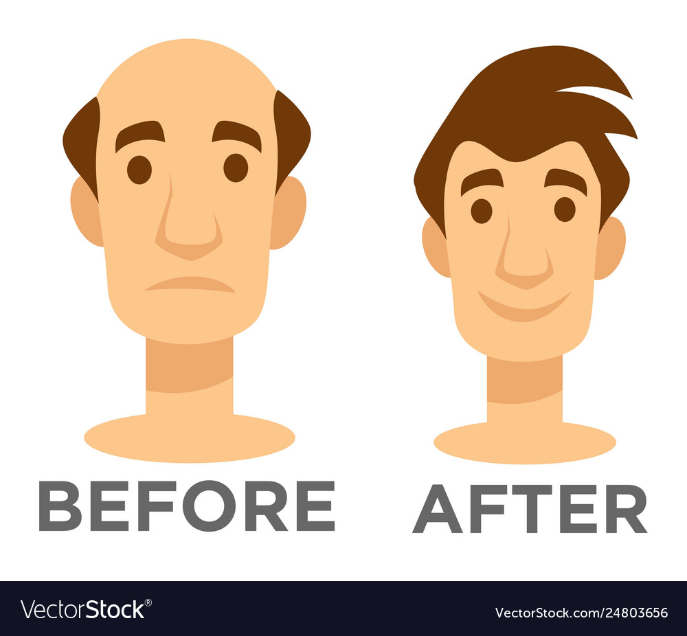 Hair Transplantation Before And After Effect Bald Vector Image