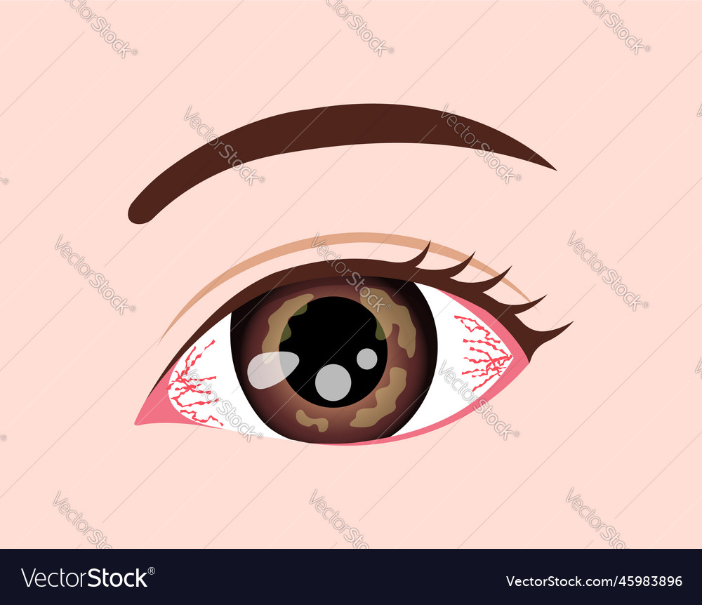 Eye disease herpetic keratitis Royalty Free Vector Image