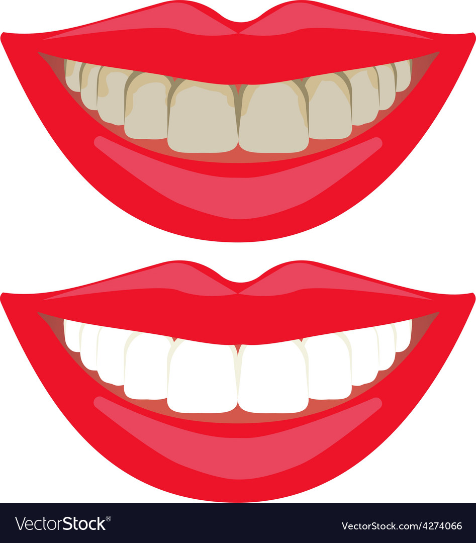 Before and after teeth whitening comparison Vector Image