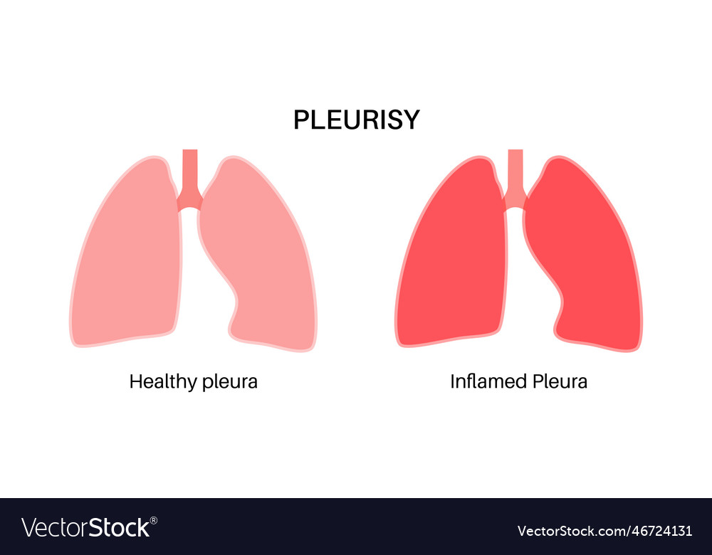 Pleurisy inflammation diseases Royalty Free Vector Image