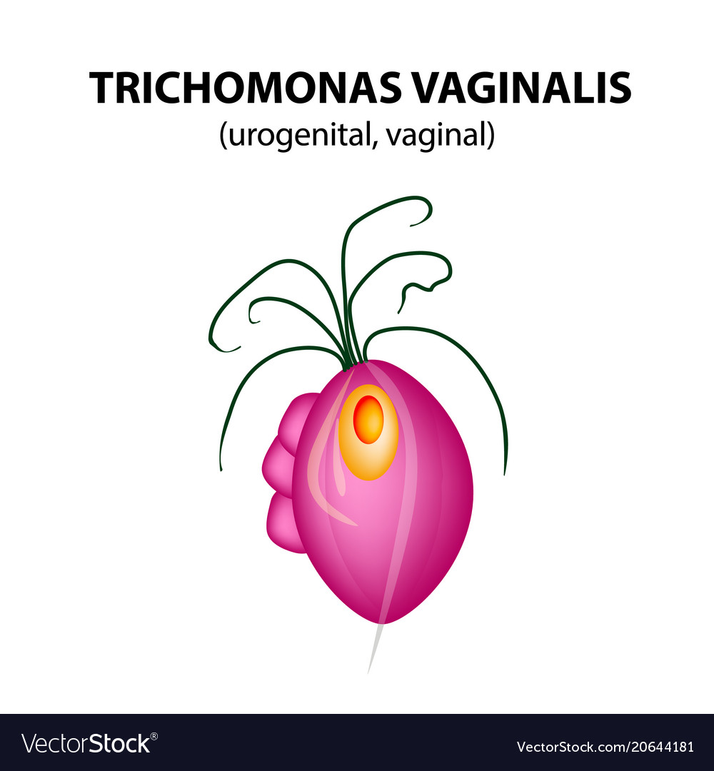 Free Art Print Of Trichomonas Vaginal Infographics Vector | My XXX Hot Girl