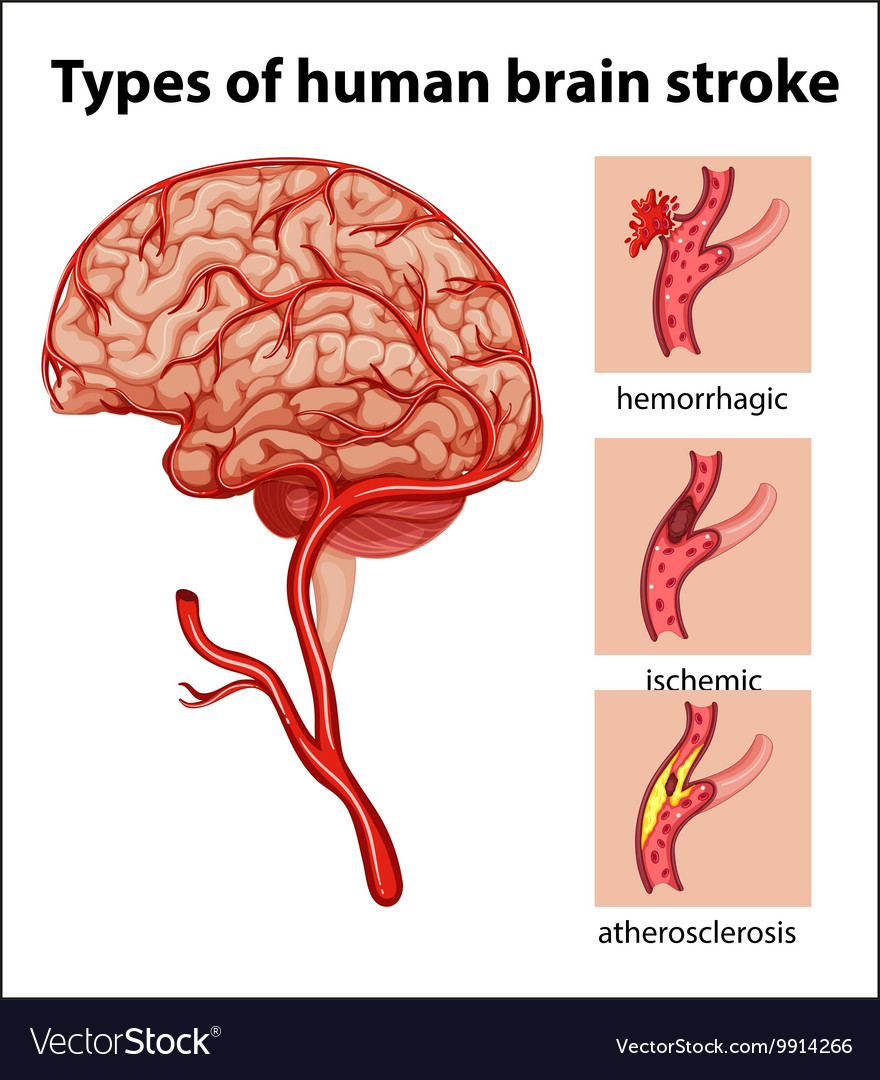 Types human brain stroke Royalty Free Vector Image