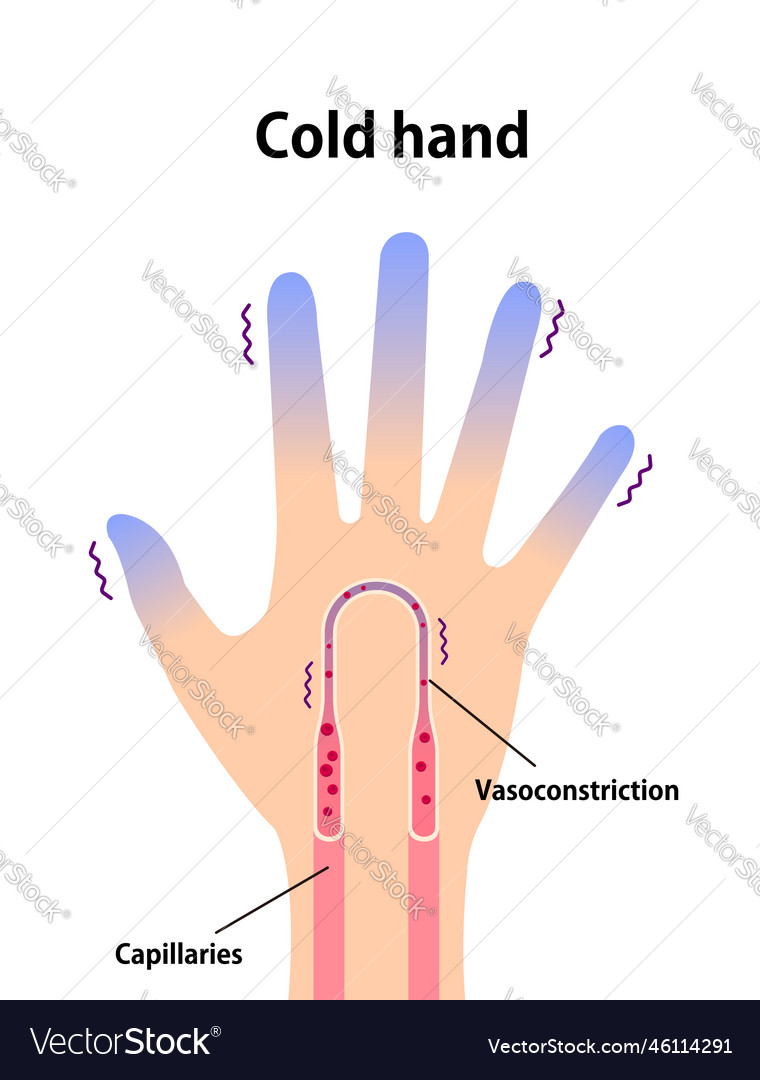 Cold hand blood circulation sensitivity to