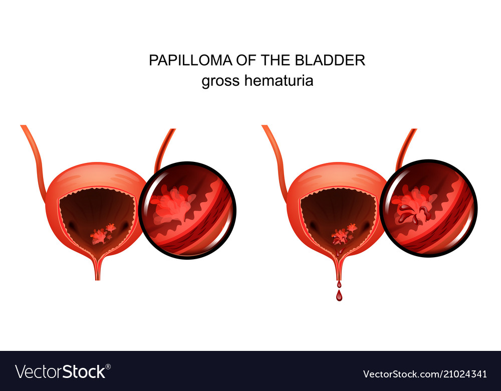 papilloma of the bladder tratamentul de viermi