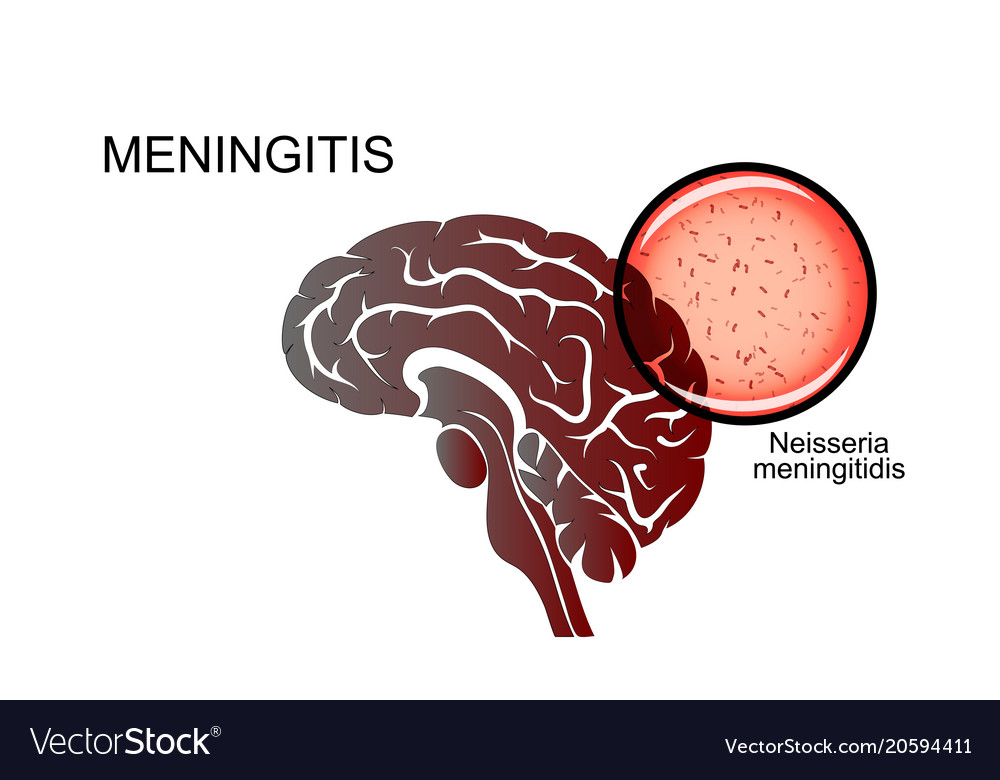 Brain Causative Agent Meningitis Royalty Free Vector Image Brain Causative Agent Meningitis Royalty Free Vector Image