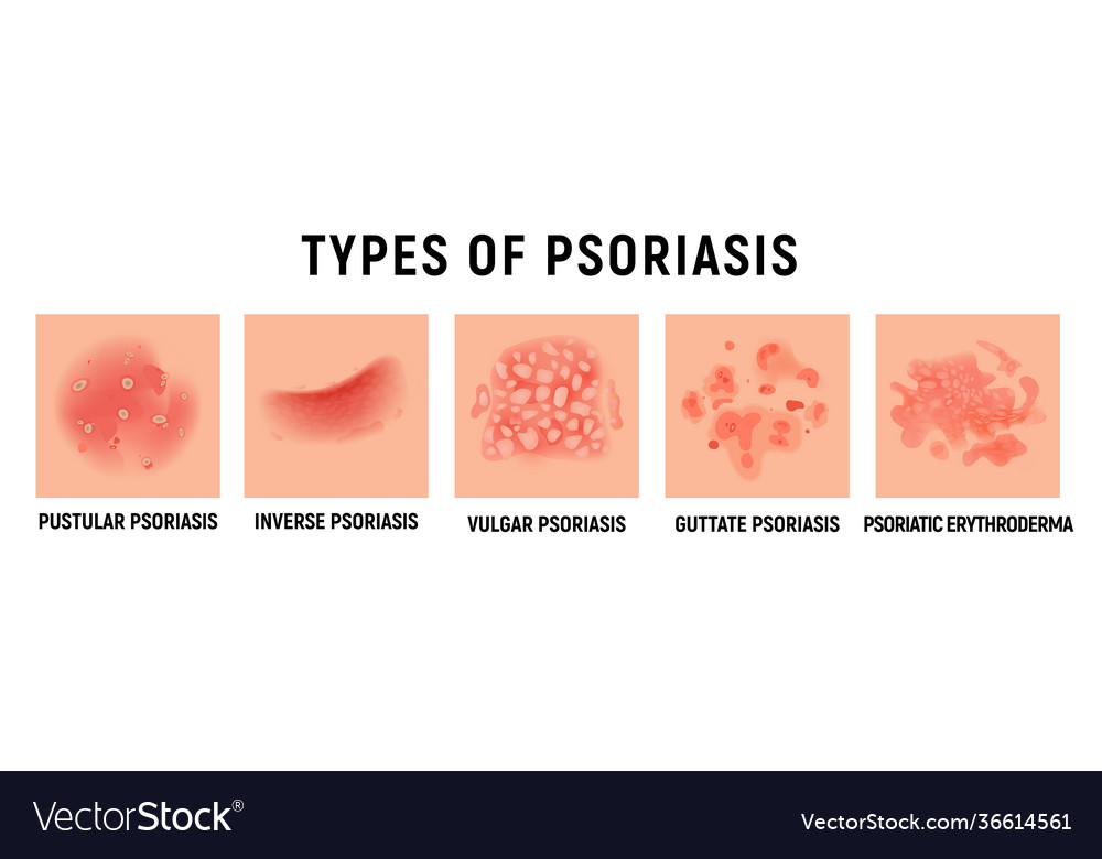 Psoriasis rash skin hand infection Royalty Free Vector Image