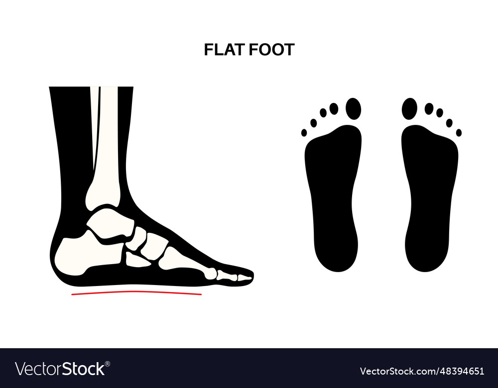 Flat feet anatomy Royalty Free Vector Image VectorStock