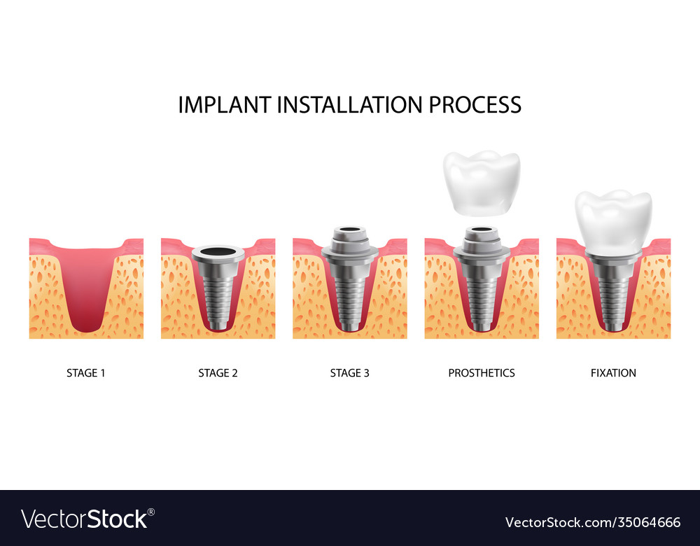 Как ставят импланты пошагово фото зубов Implant installation stages Royalty Free Vector Image