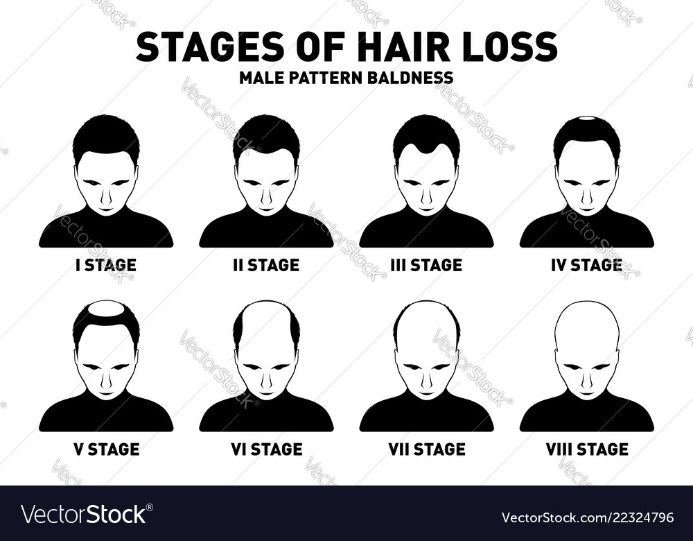 Hair Loss Stages And Types Of Male Hair Loss Male Vector Image