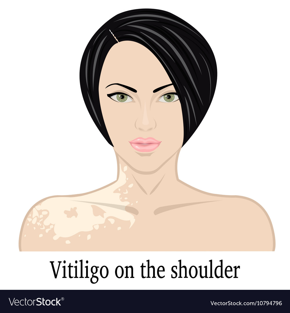 Vitiligo on the shoulder