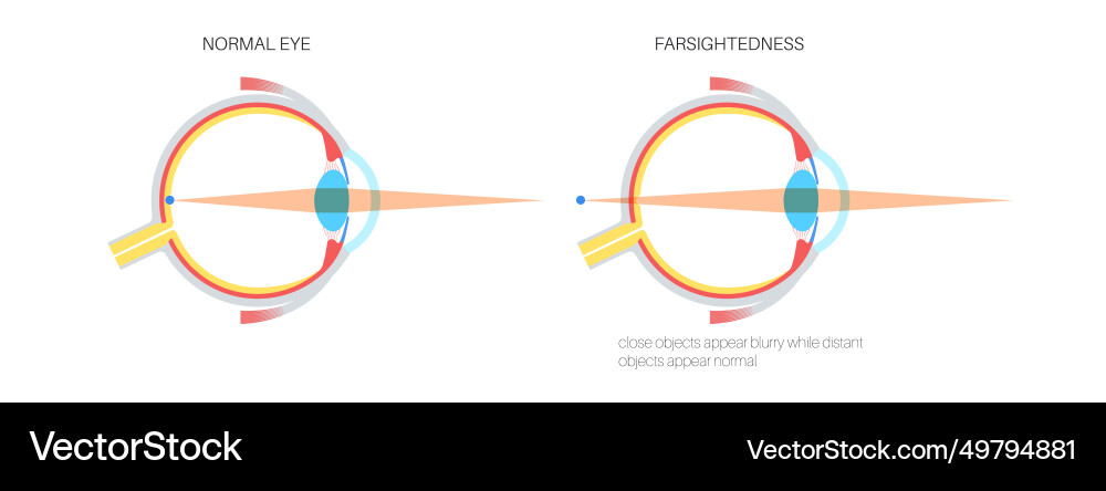 Normal eye and farsightedness Royalty Free Vector Image