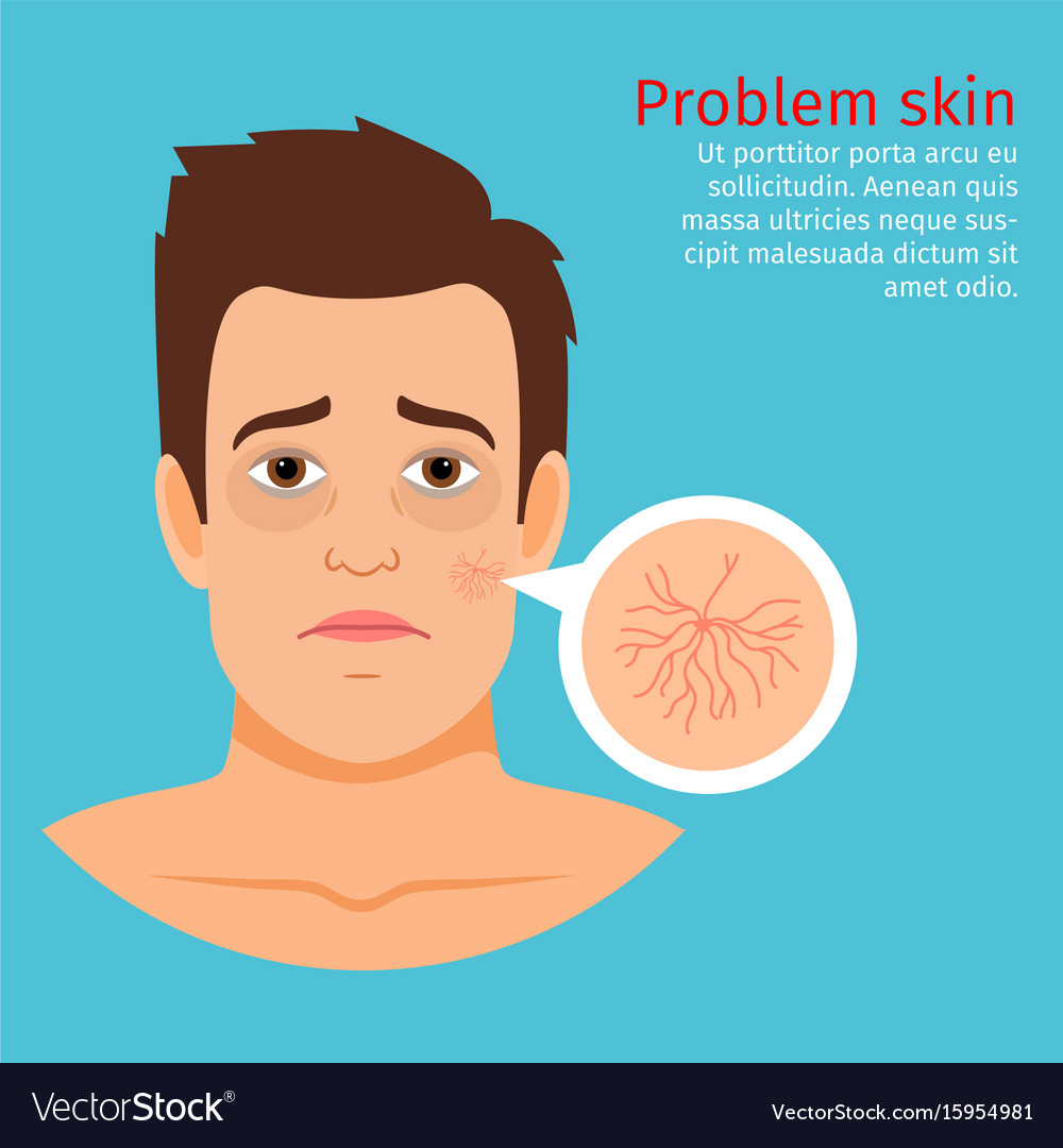 Man face skin problem buried capillaries