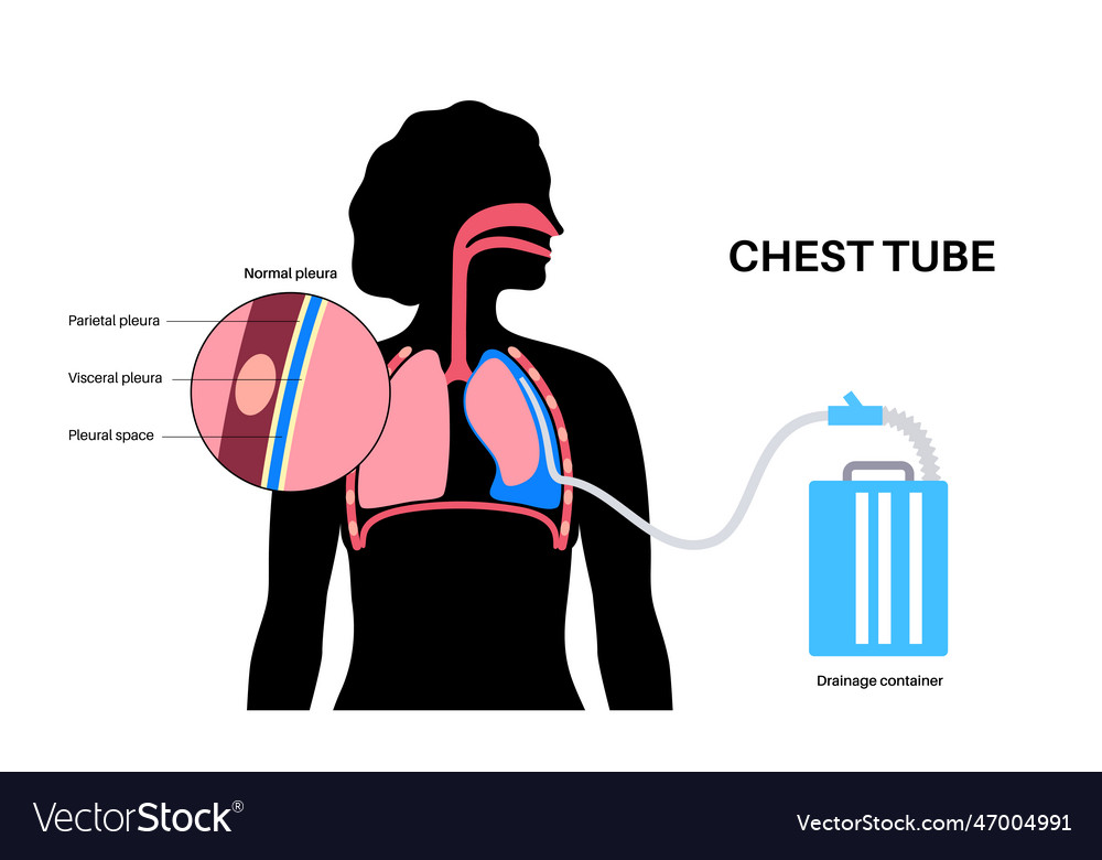 Chest tube catheter Royalty Free Vector Image - VectorStock