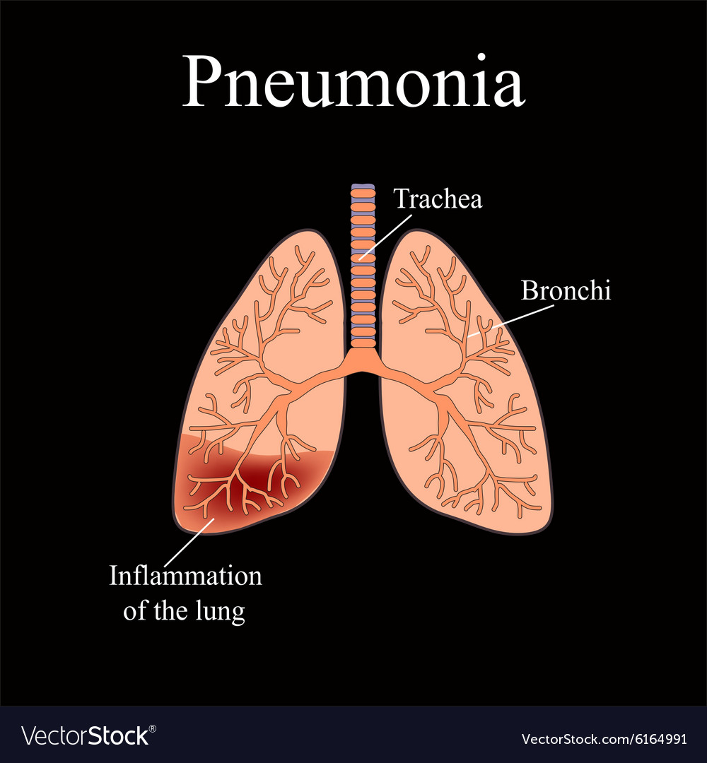 Pneumonia the anatomical structure of human Vector Image