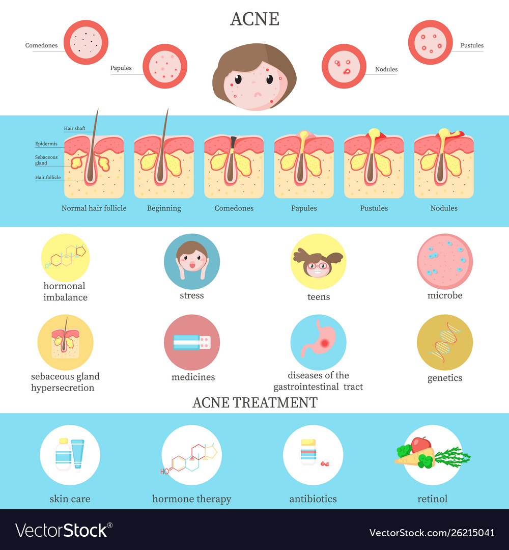 Acne Types Causes And Treatment Infographics Vector Image