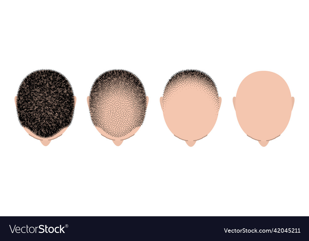 Haarausfall - Alopecia Behandlung