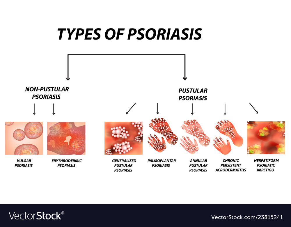 Types Of Psoriasis Pustular Royalty Free Vector Image