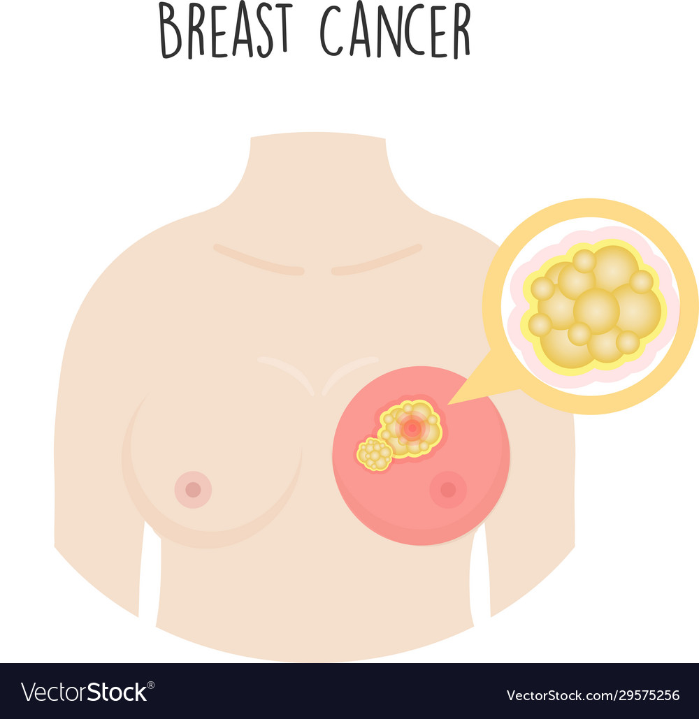 Breast cancer in cartoon style