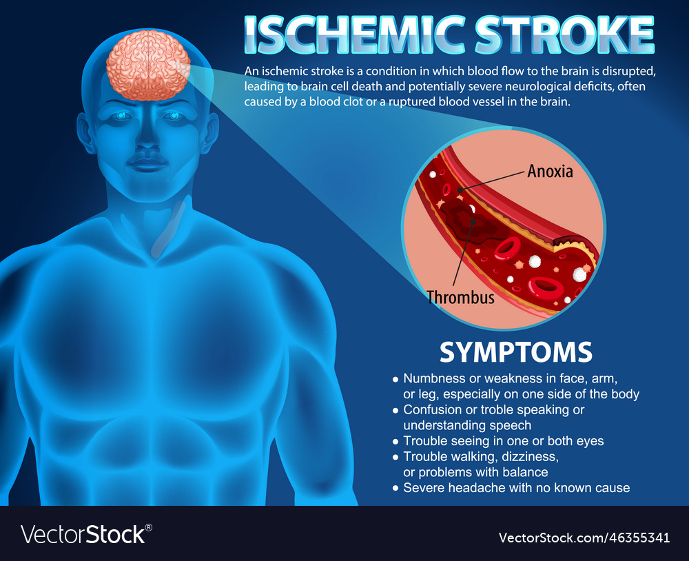 Informative poster of ischemic stroke Royalty Free Vector