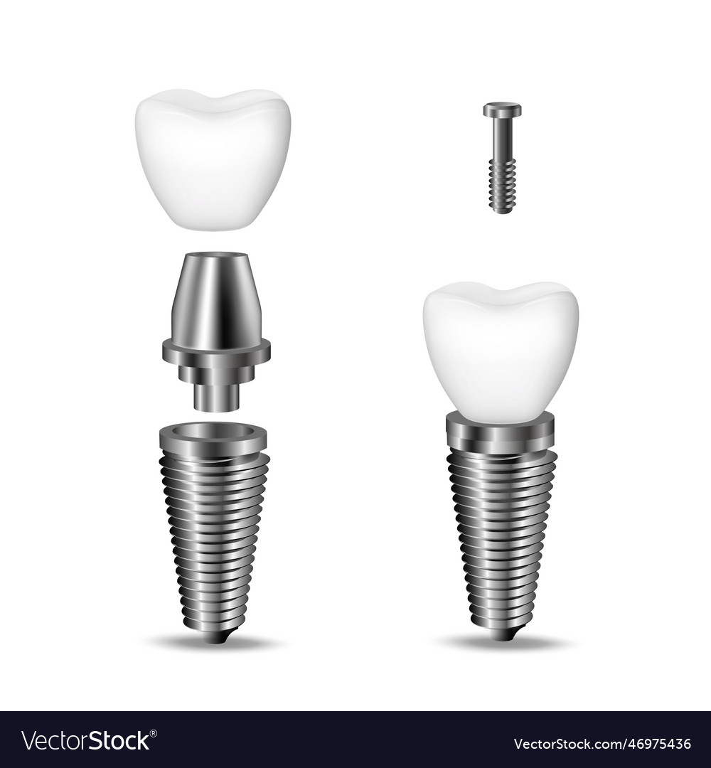 Realistic 3d set of dental implants structural Vector Image