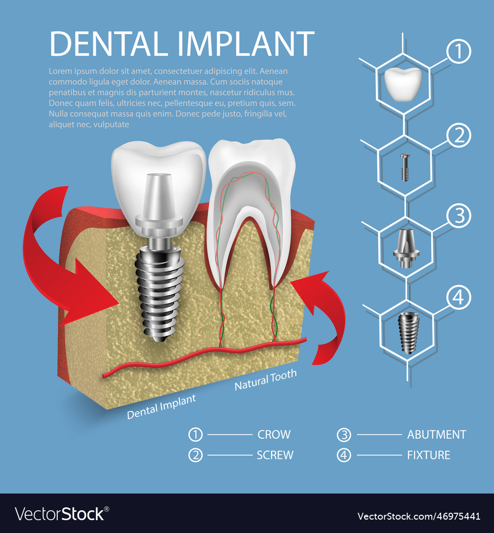 Human teeth and dental implant in gum mockup