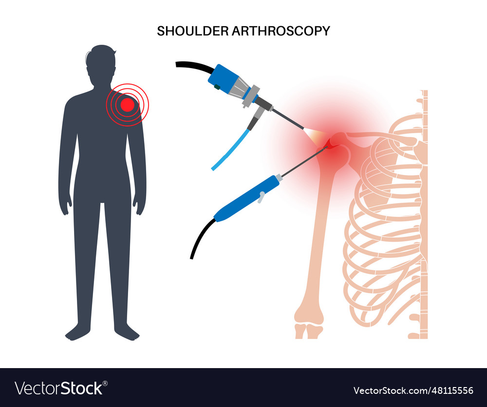 Shoulder arthroscopy poster Royalty Free Vector Image