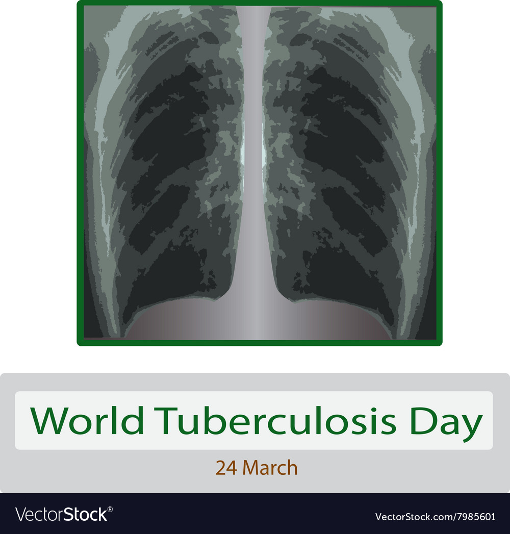 X-rays of light diagnosis tuberculosis