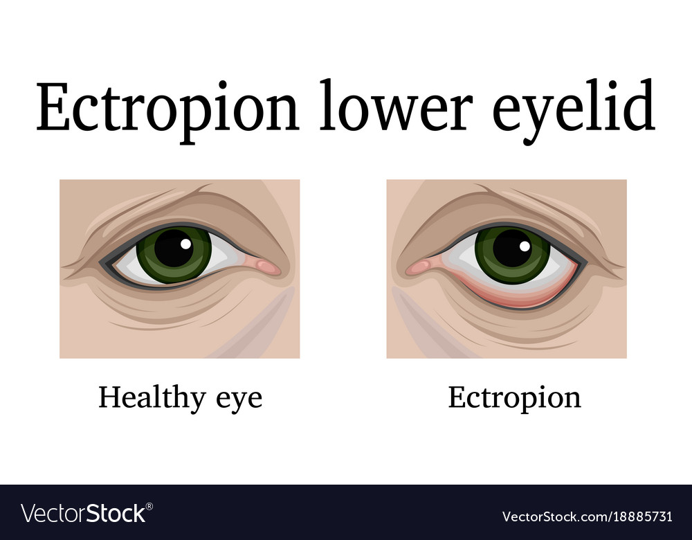 icd 10 code for senile ectropion of eyelid left lower