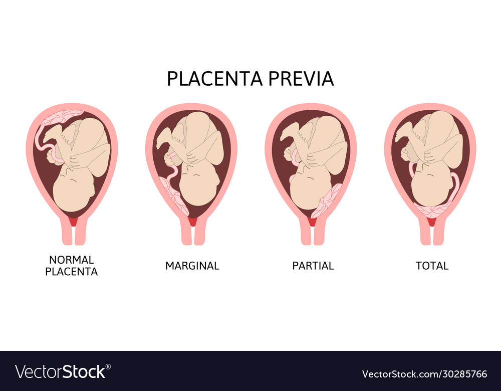 Different placental locations during pregnancy Vector Image