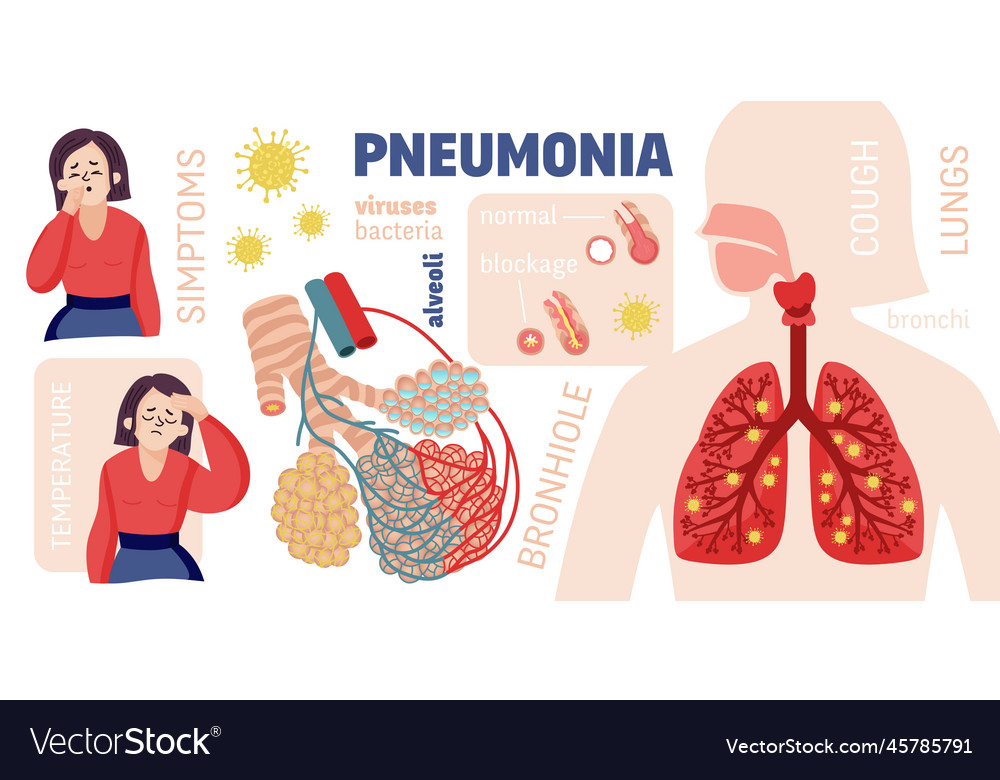 Human pneumonia cartoon infographics Royalty Free Vector