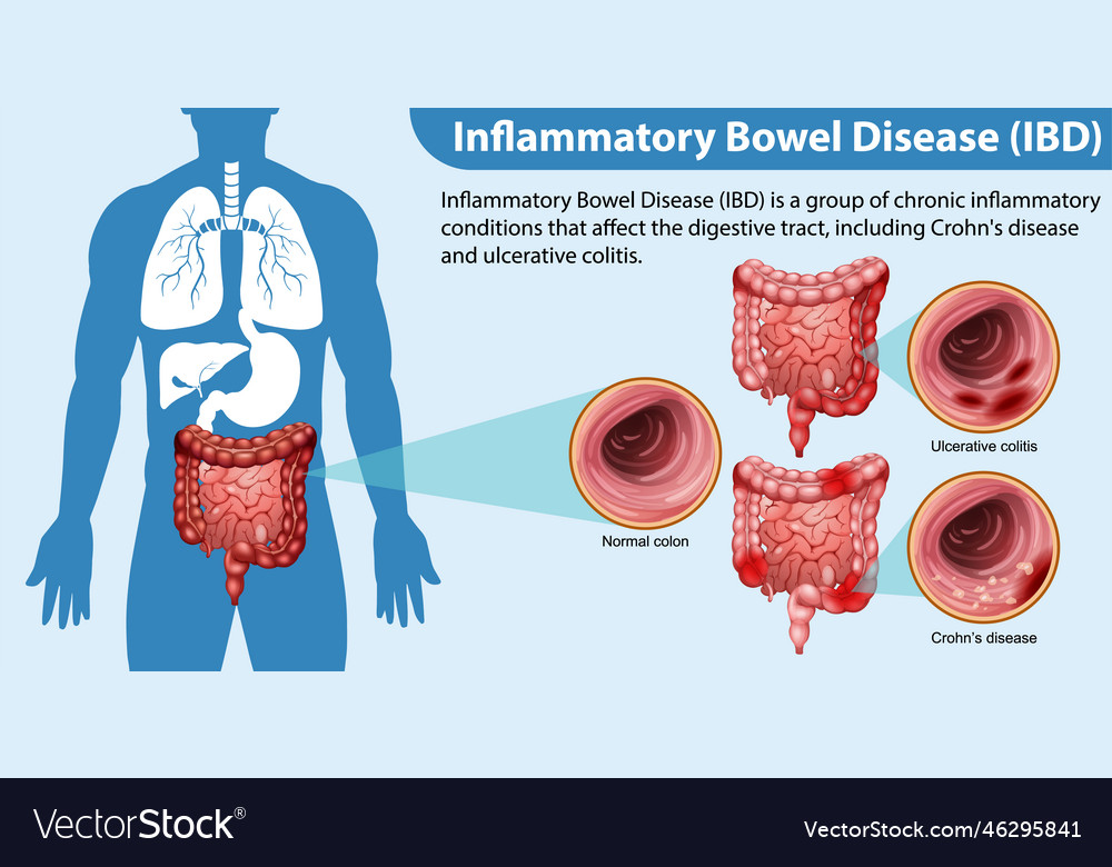 Inflammatory bowel disease ibd infographic Vector Image