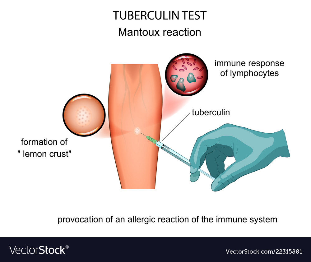 Tuberculin Test Mantoux Royalty Free Vector Image