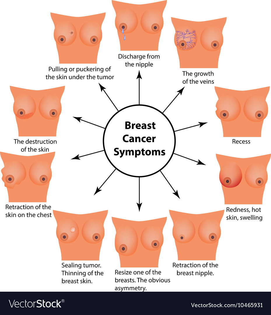 Symptoms of breast cancer Infographics Royalty Free Vector