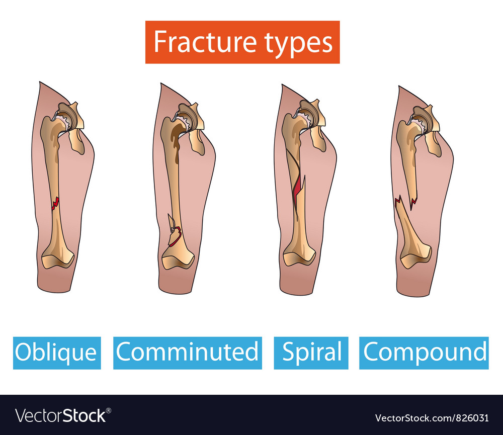 Types of fractures