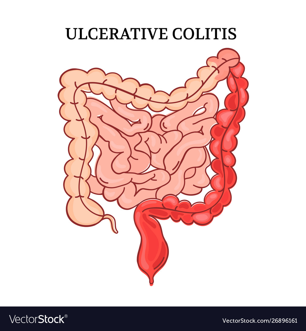 Ulcerative colitis intestines medicine anatomy vec