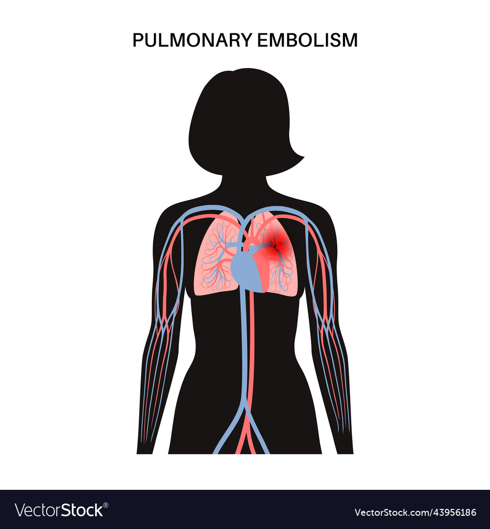 Pulmonary embolism disease Royalty Free Vector Image