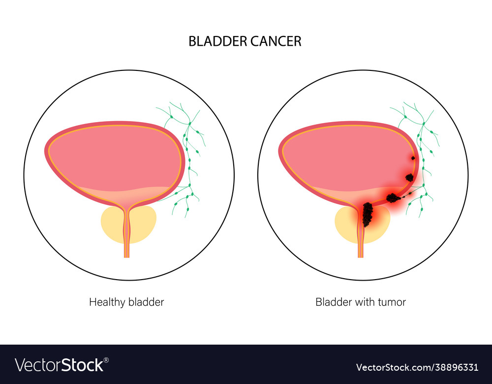 Bladder cancer stages Royalty Free Vector Image