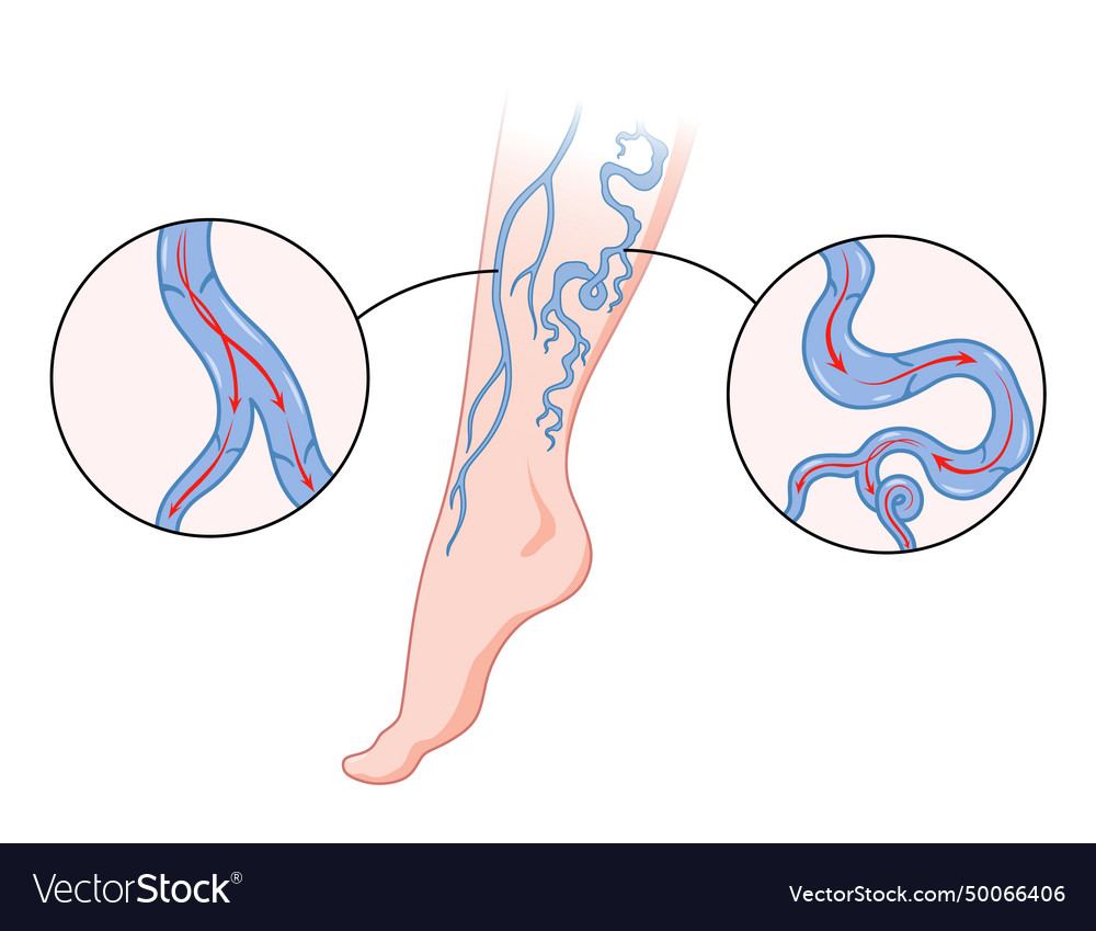 Varicose veins blue blood vessel visible through Vector Image