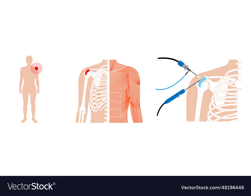 Shoulder arthroscopy poster Royalty Free Vector Image