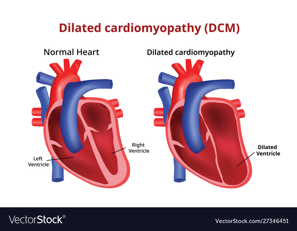 Dilated Cardiomyopathy Heart Disease Image Vector Image