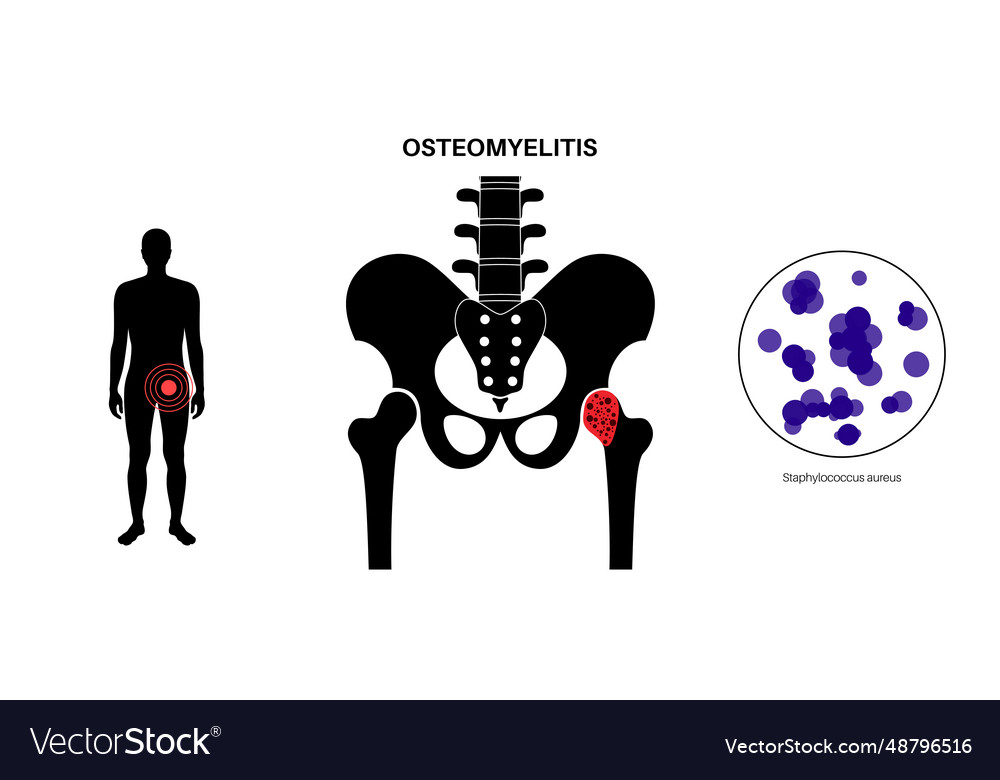 Osteomyelitis of hip