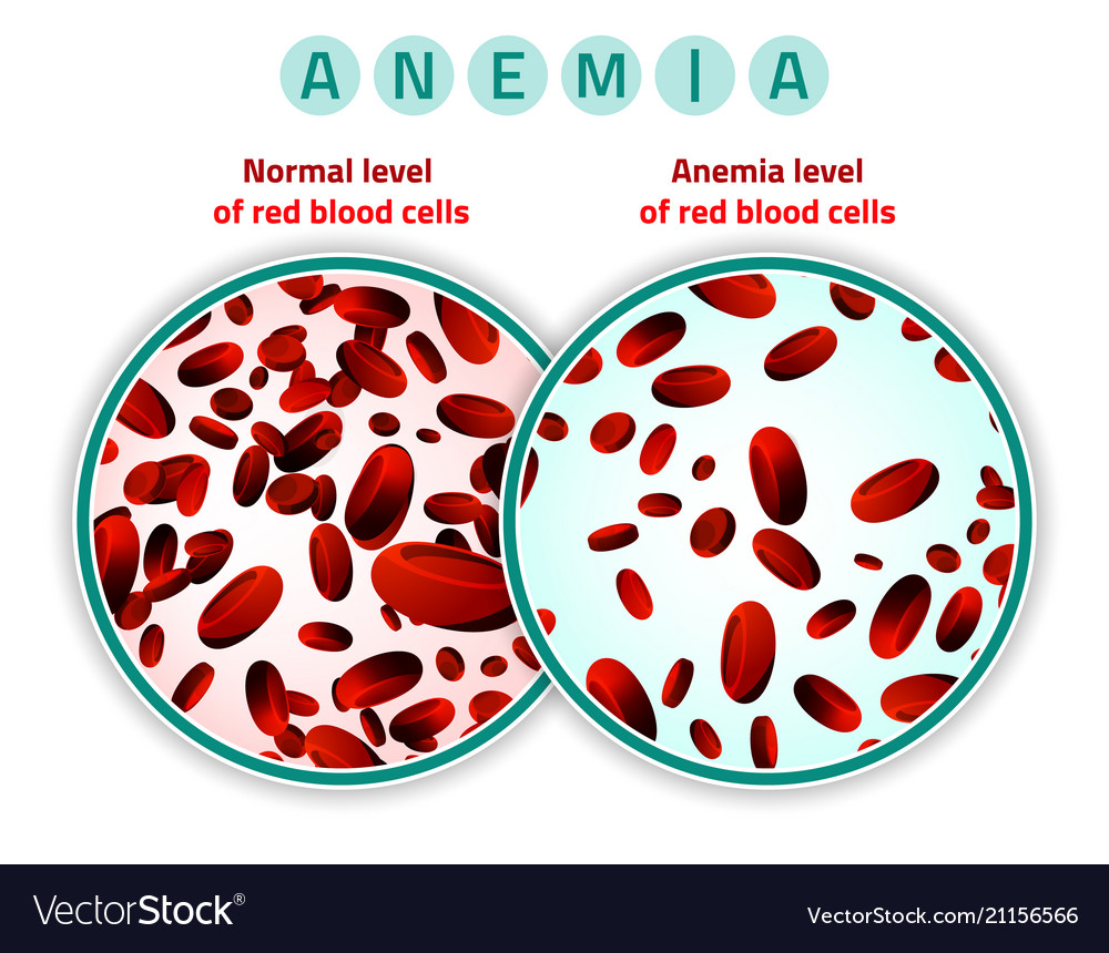 Anemia level of blood cells Royalty Free Vector Image