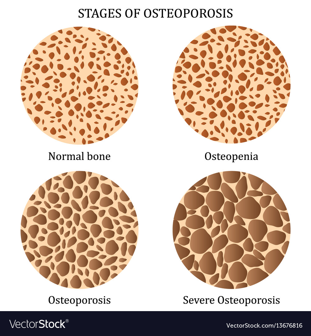 Stages of osteoporosis Royalty Free Vector Image