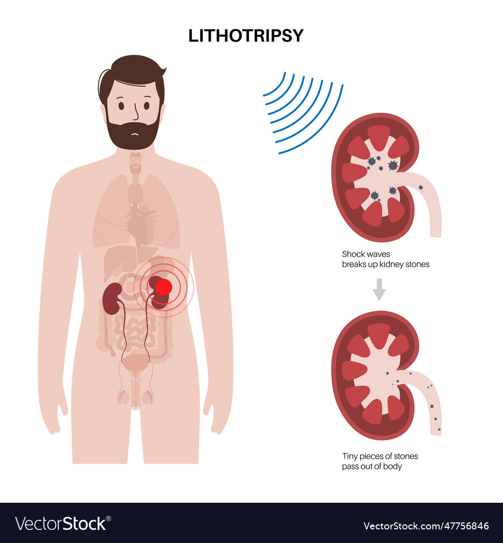 Lithotripsy procedure concept vector image Lithotripsy procedure concept