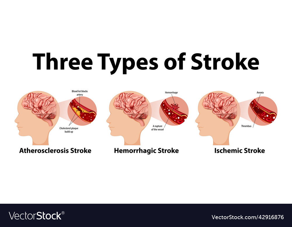 there-are-three-types-of-strokes-hemorrhagic-stroke-ischemic-stroke