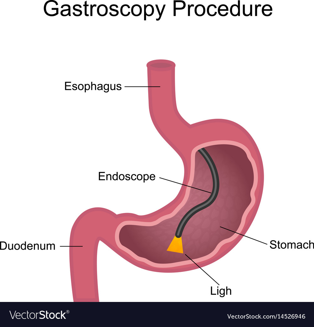 Gastroscopy Procedure Diagram Royalty Free Vector Image